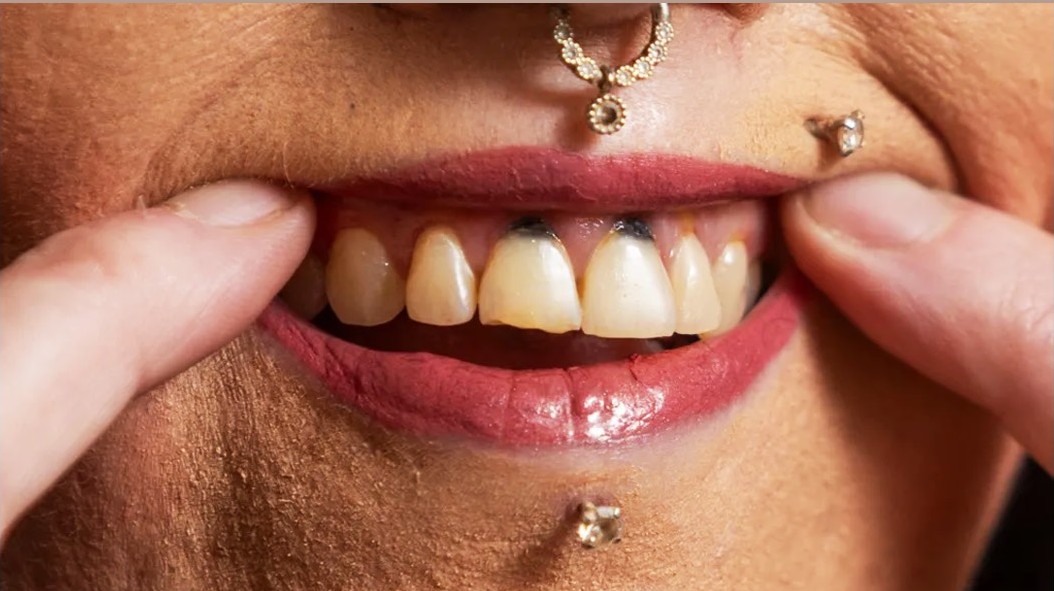 สาวเลิกสูบบุหรี่ไฟฟ้าหลังเกิด“จุดดำ”ที่ฟันหน้า