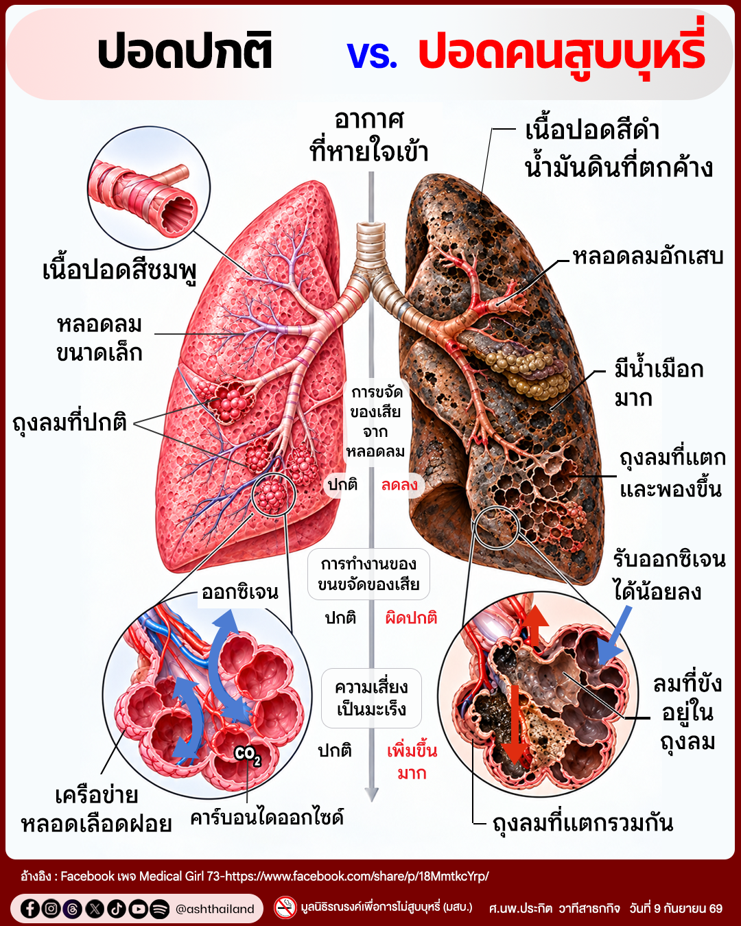 โรคถุงลมโป่งพอง ทรมานที่สุด และ ตายช้าที่สุด